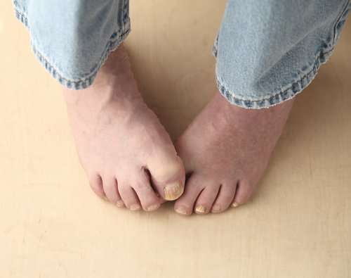 How to Treat Your Toenail Fungus at Home?