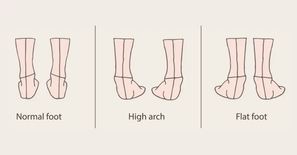 Learn Your Foot Arch Type With The Wet Test