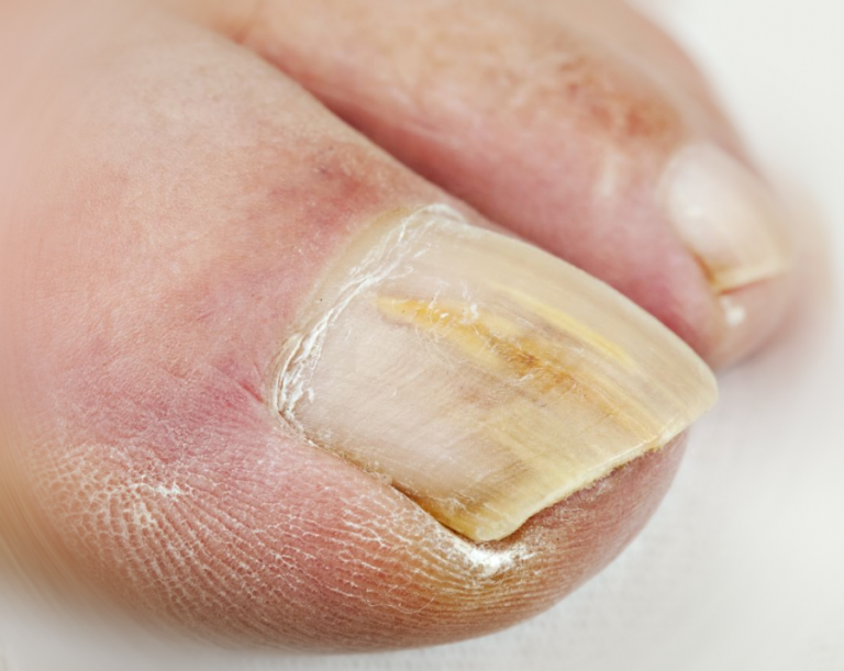 Toenail problems and easy ways to treat them