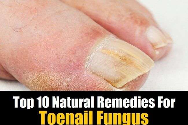 Top 10 Home Remedies To Get Rid Of Toenail Fungus Fast ...